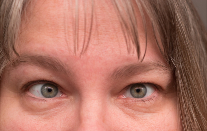 Up close image of a woman's upper face, showing signs of lazy eye in adults.