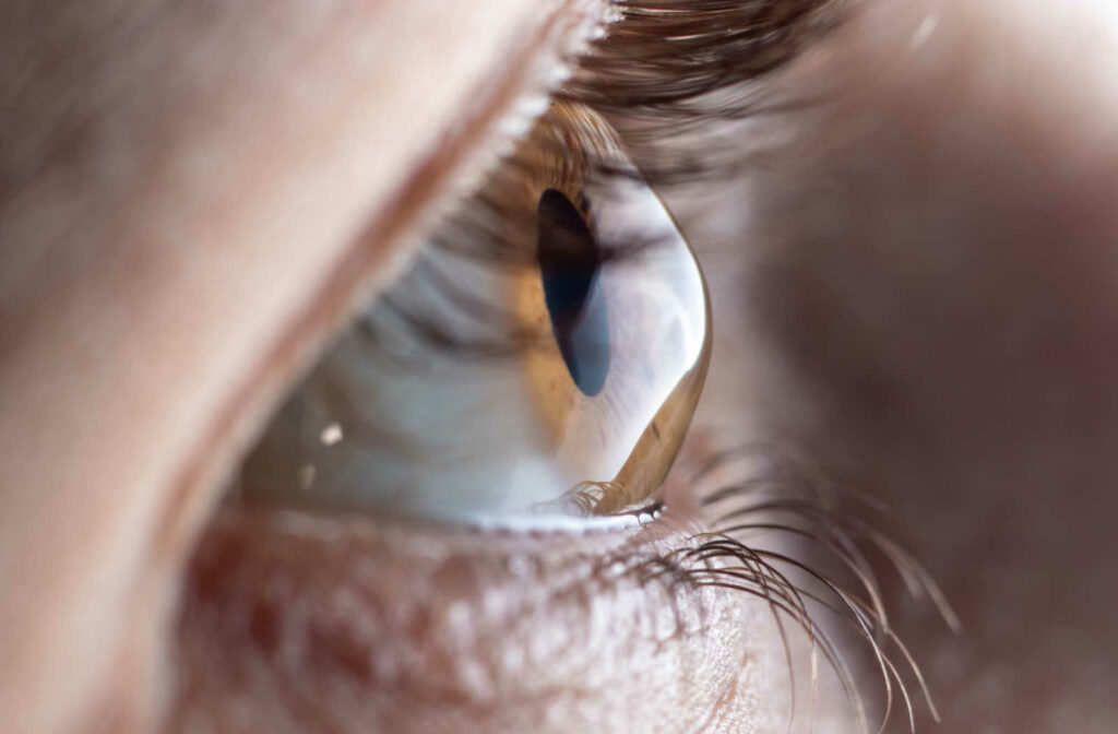 Up close image of an eye with an astigmatism.