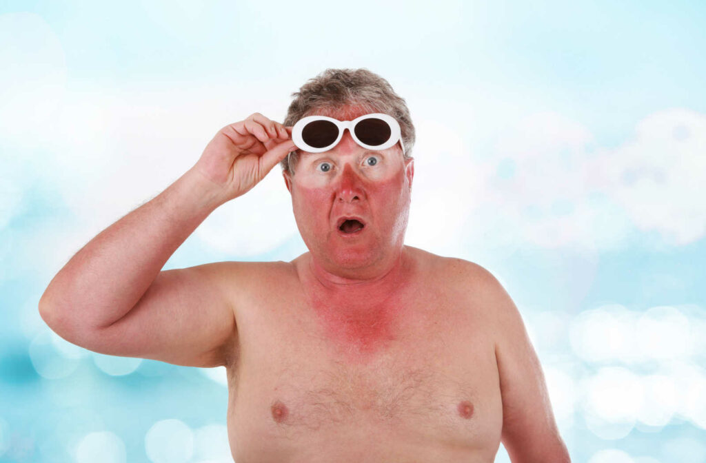A sunburned man used sunglasses to protect his eyes from the harmful UV rays of the sun.