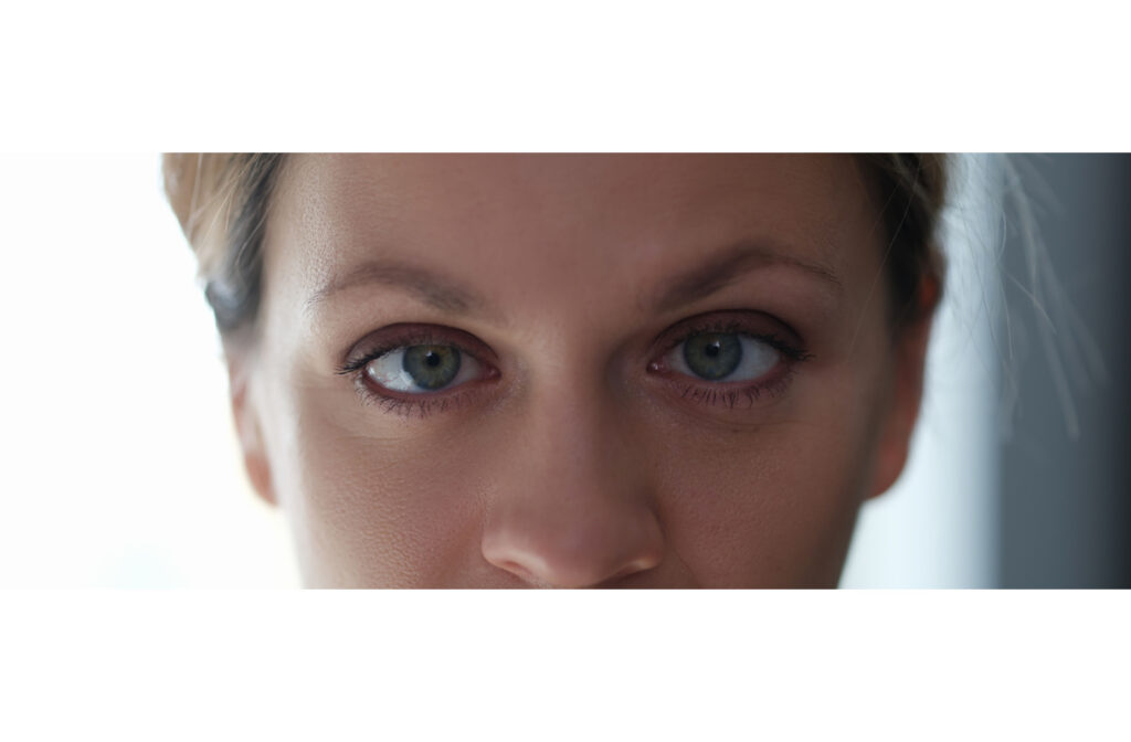 Up close image of a woman with a lazy eye.