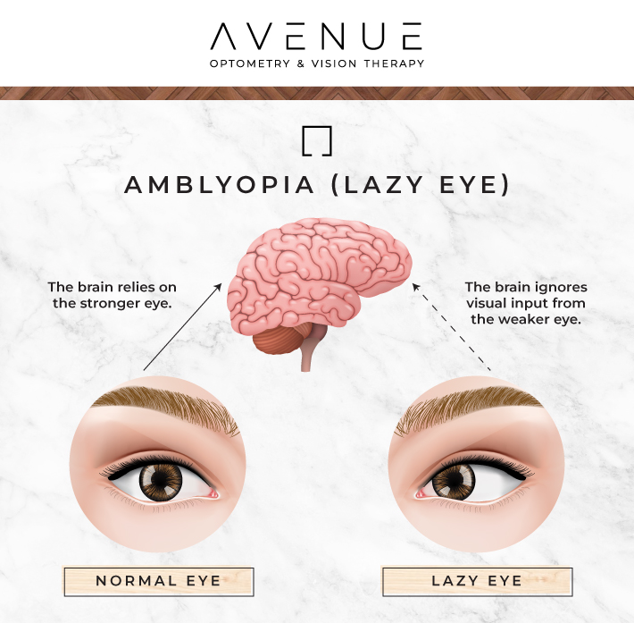 Infographic showing alignment of normal eye vs lazy eye.